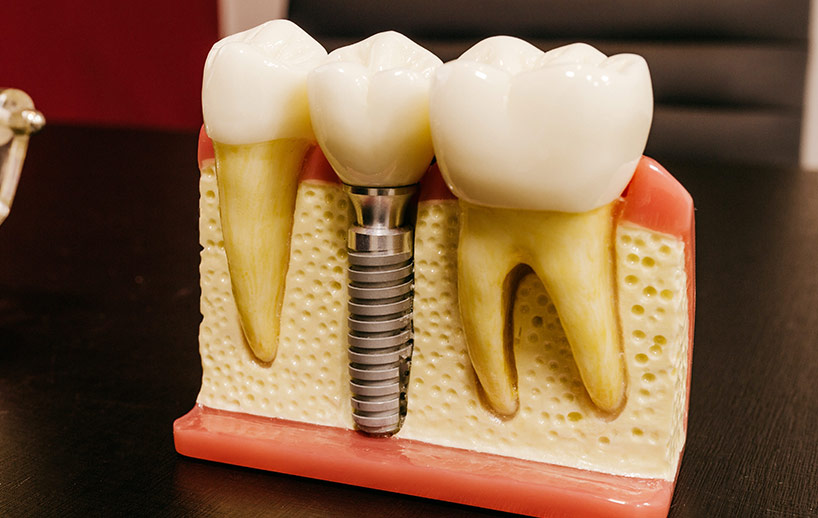 dental-implants
