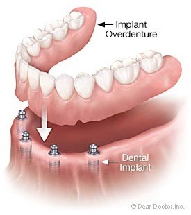 implant-denture