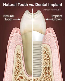 implant